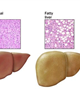 كبد چرب دست آوردي از چاقي