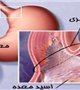 نداشتن تحرک علت افزایش شیوع ریفلاکس معده در افراد 